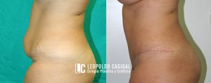 fotos antes y después abdominoplastia Málaga