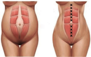 cirugia diastasis rectos abdominales
